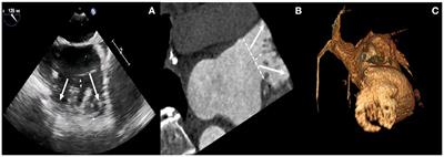 Occlusion of Bilobulated Left Atrial Appendage Using the Dual-Watchman Technique: A Long-Term Follow-Up Study